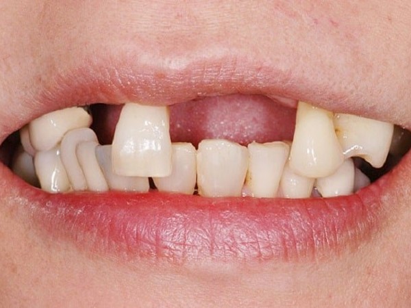 Nằm mơ thấy rụng 3 cái răng có phải dấu hiệu mất mát?