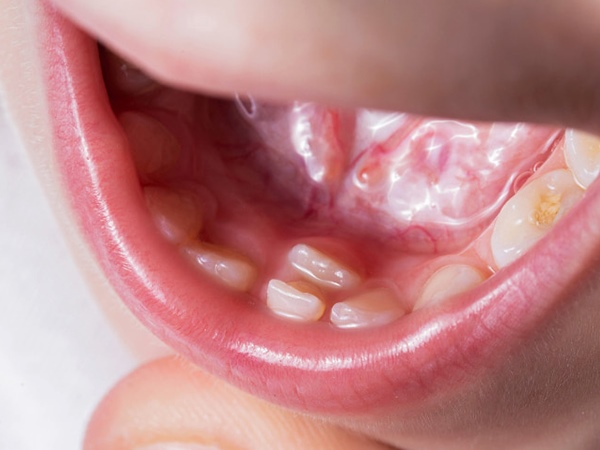 Nằm mơ thấy rụng 3 cái răng có phải dấu hiệu mất mát?